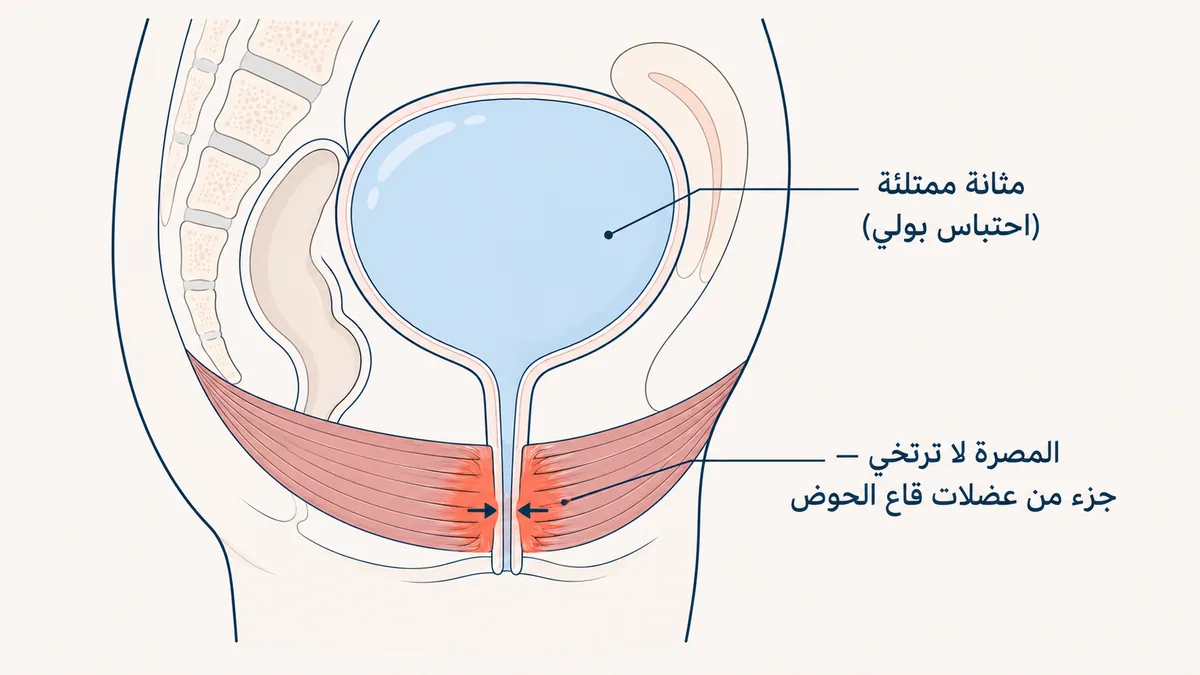 رسمٌ توضيحيٌّ لآلية متلازمة فاولر: مثانة ممتلئة باحتباس البول مع مصرةٍ إحليليةٍ خارجية لا ترتخي فتعيق خروج البول
