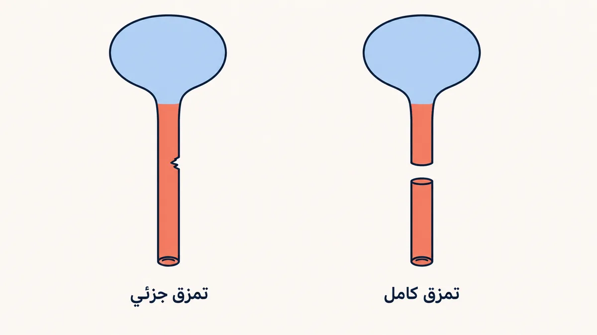 رسمٌ توضيحيٌّ يقارن التمزق الجزئي للإحليل الذي يبقى فيه متصلاً بالتمزق الكامل الذي ينفصل فيه الإحليل إلى جزأين